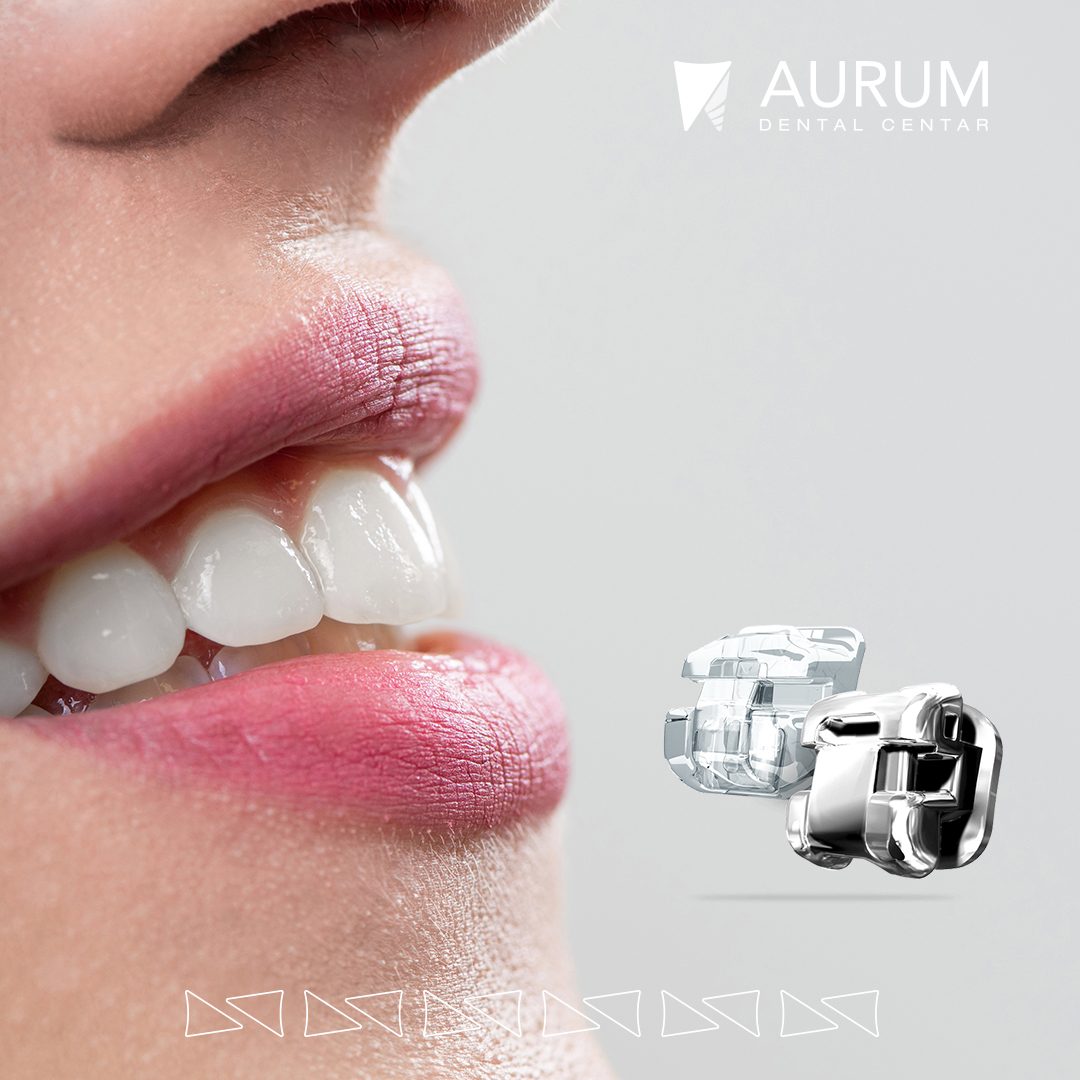 Damon ortodontski aparatići