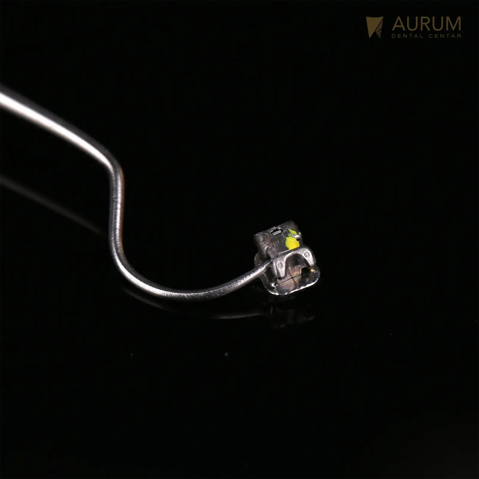 Fiksna proteza: Savjeti i sve što treba da znate