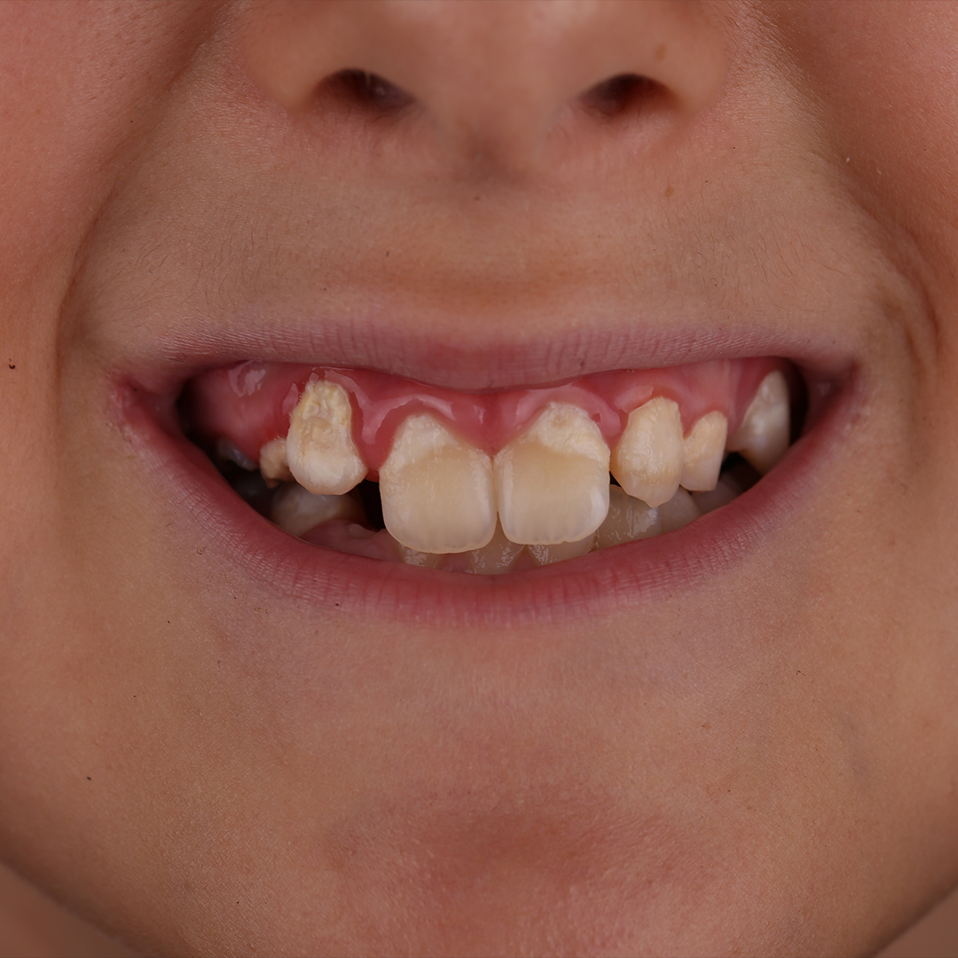 Karijes na mliječnim zubima: Šta roditelji trebaju znati?